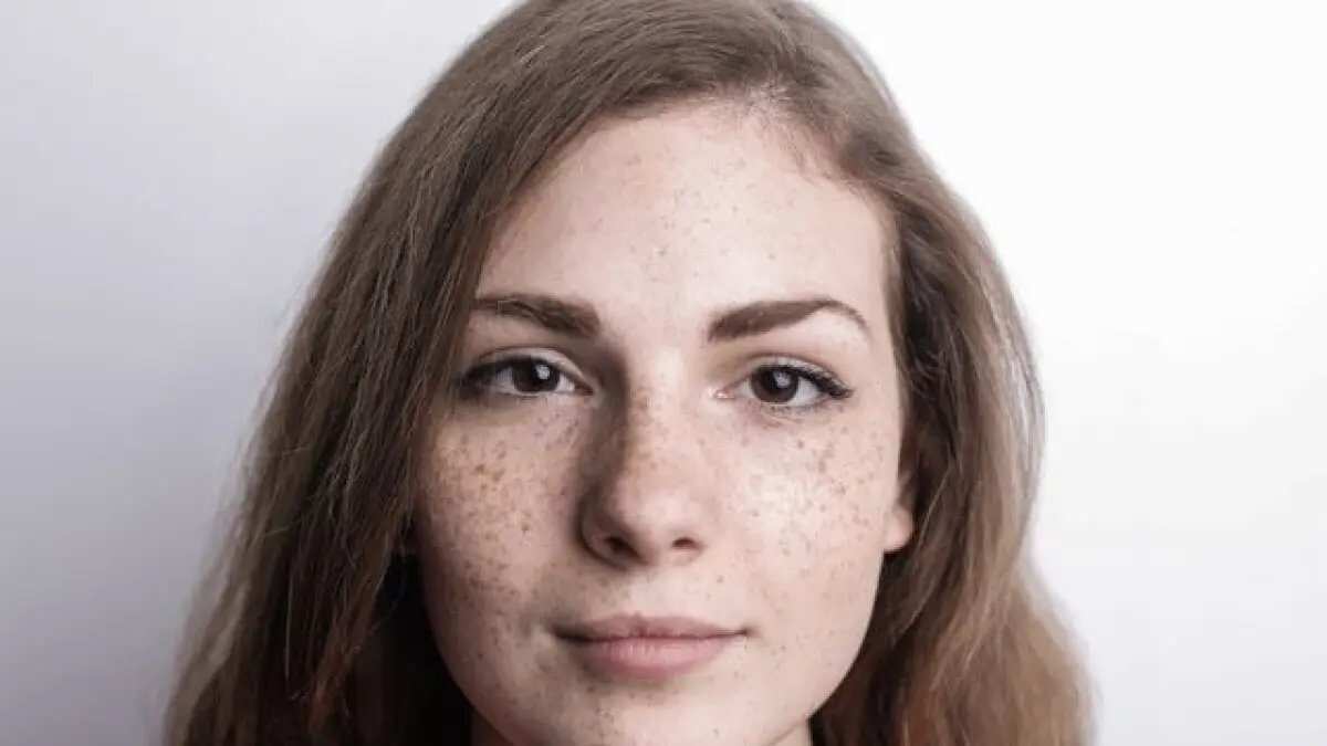 Cara Merawat Dermatitis Perioral dengan Rutinitas Skincare yang Tepat Cara Merawat Dermatitis Perioral dengan Rutinitas Skincare yang Tepat