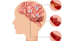 Studi Menyoroti Kerugian Waktu pada Pasien Stroke di Indonesia Studi Menyoroti Kerugian Waktu pada Pasien Stroke di Indonesia