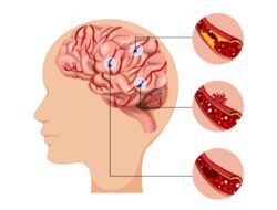 Studi Menyoroti Kerugian Waktu pada Pasien Stroke di Indonesia