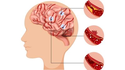 Studi Menyoroti Kerugian Waktu pada Pasien Stroke di Indonesia Studi Menyoroti Kerugian Waktu pada Pasien Stroke di Indonesia
