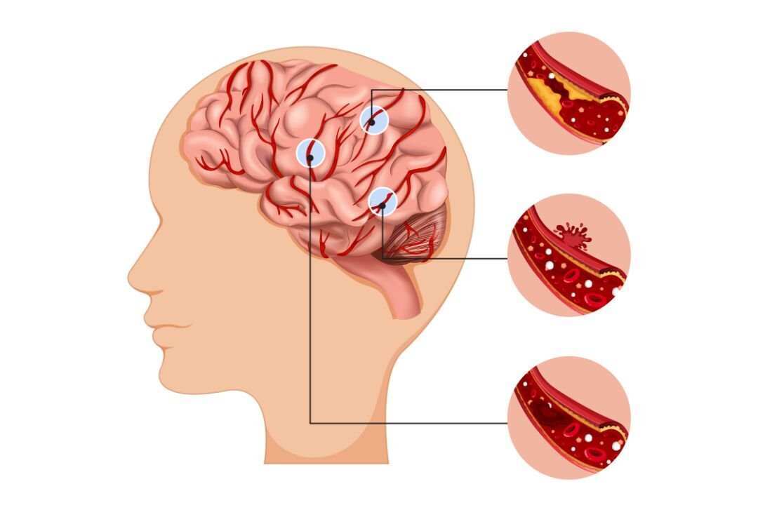 Studi Menyoroti Kerugian Waktu pada Pasien Stroke di Indonesia Studi Menyoroti Kerugian Waktu pada Pasien Stroke di Indonesia